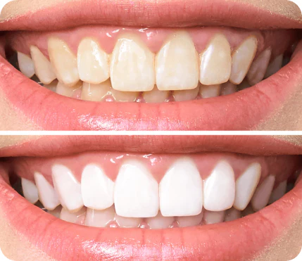 Teeth whitening