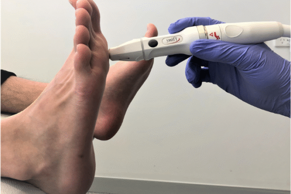 Swift Microwave Therapy A Smart Solution for Stubborn Warts Swift Microwave Therapy A Smart Solution for Stubborn Warts
